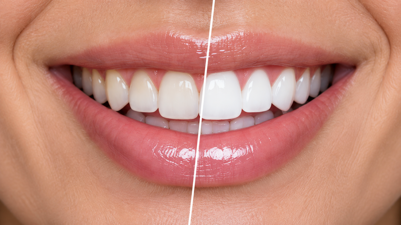 Illustrative whitening comparison